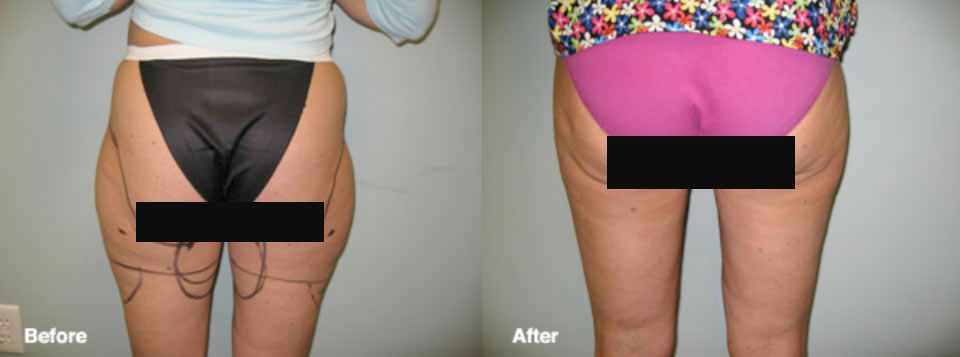 smartlipo manhattan